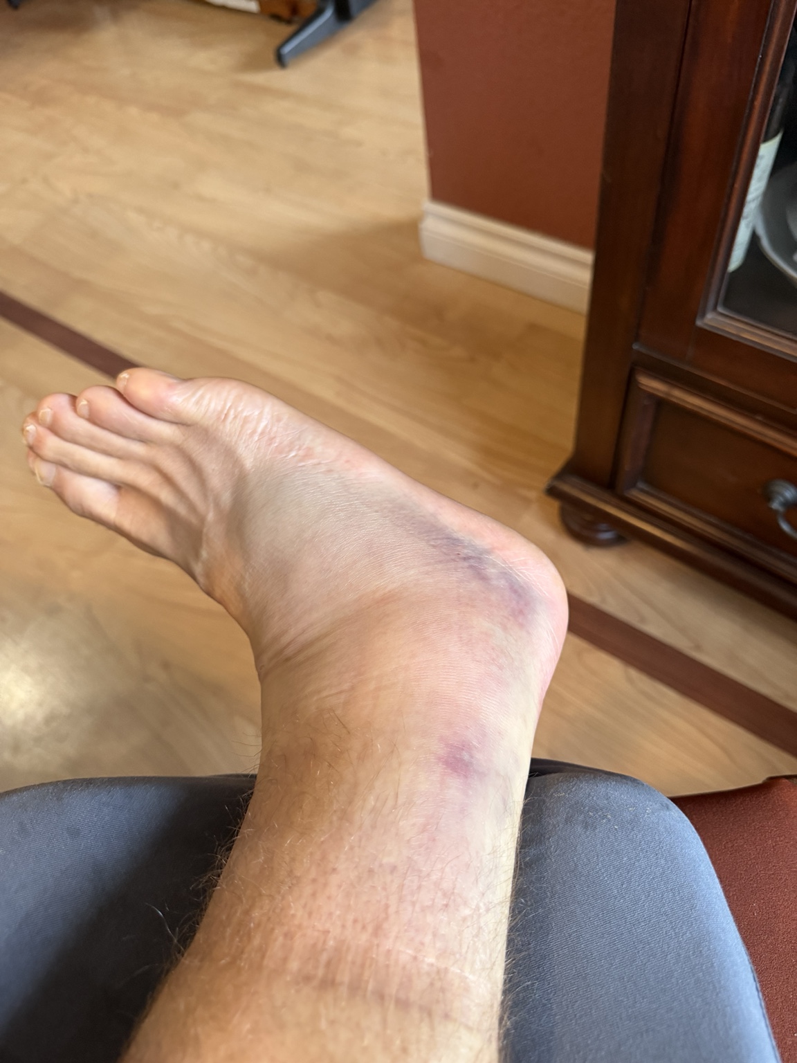 Matthew’s swollen and bruised ankle resting during an unexpected pause in his Pacific Coast run