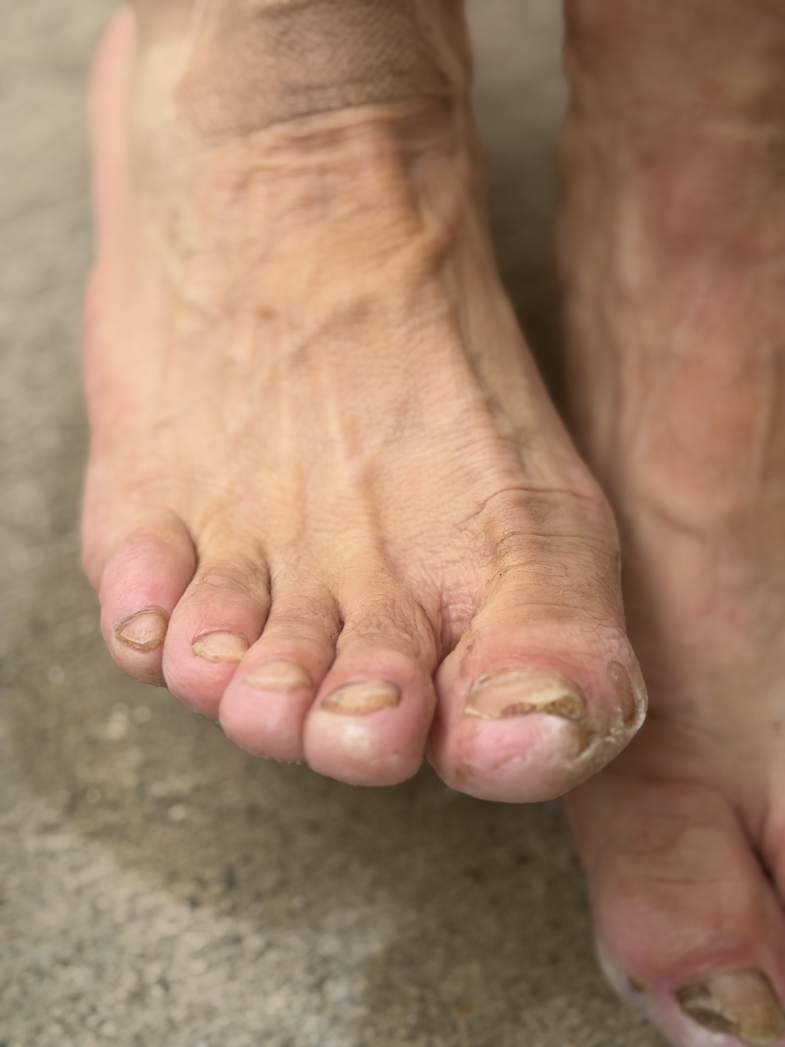 Close-up of Matthew’s left foot after eleven days on the road