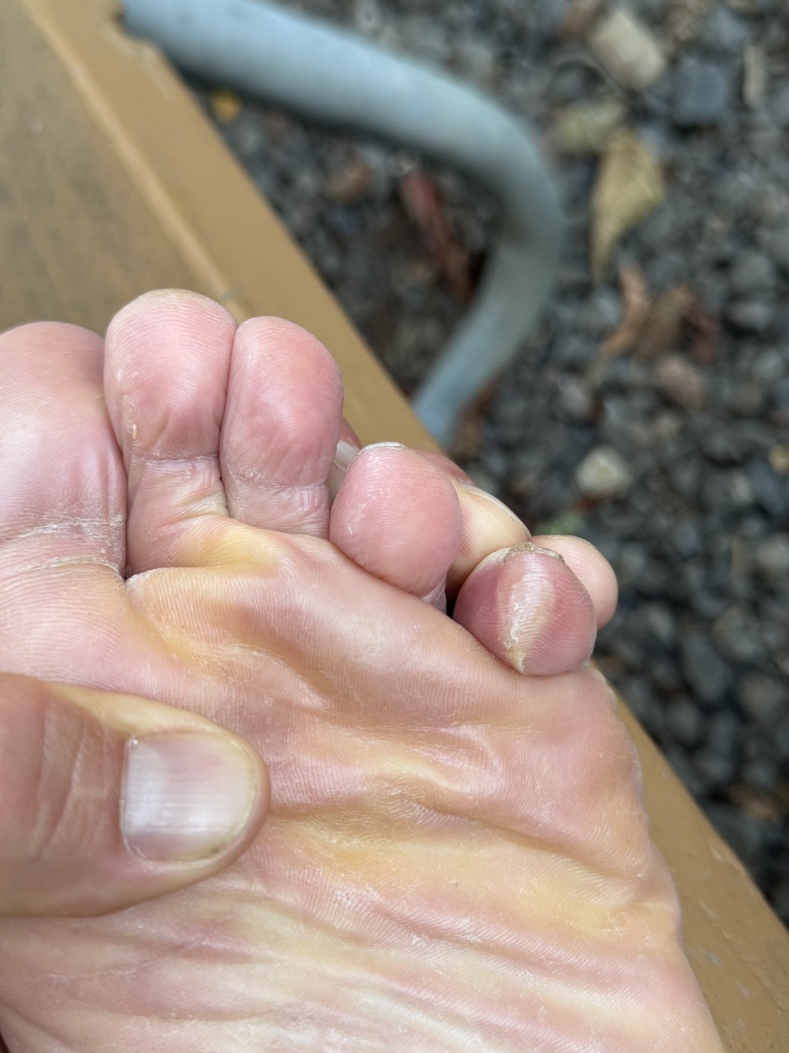 A close-up of Matthew's blistered and callused foot after many miles on the road