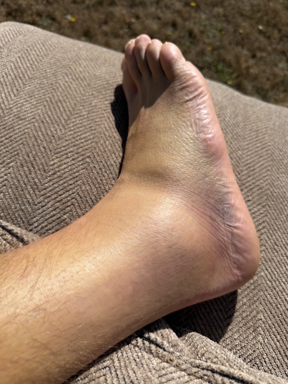 Close view of the early bruising and swelling around Matthew’s injured ankle